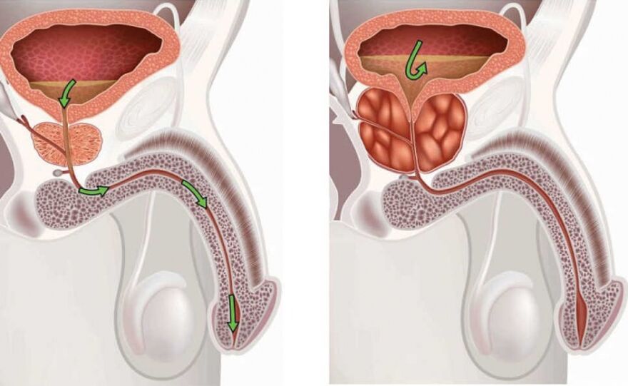 Informácie o ochorení prostatitída