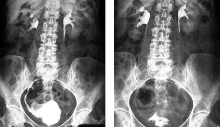 urografia na diagnostiku prostatitídy